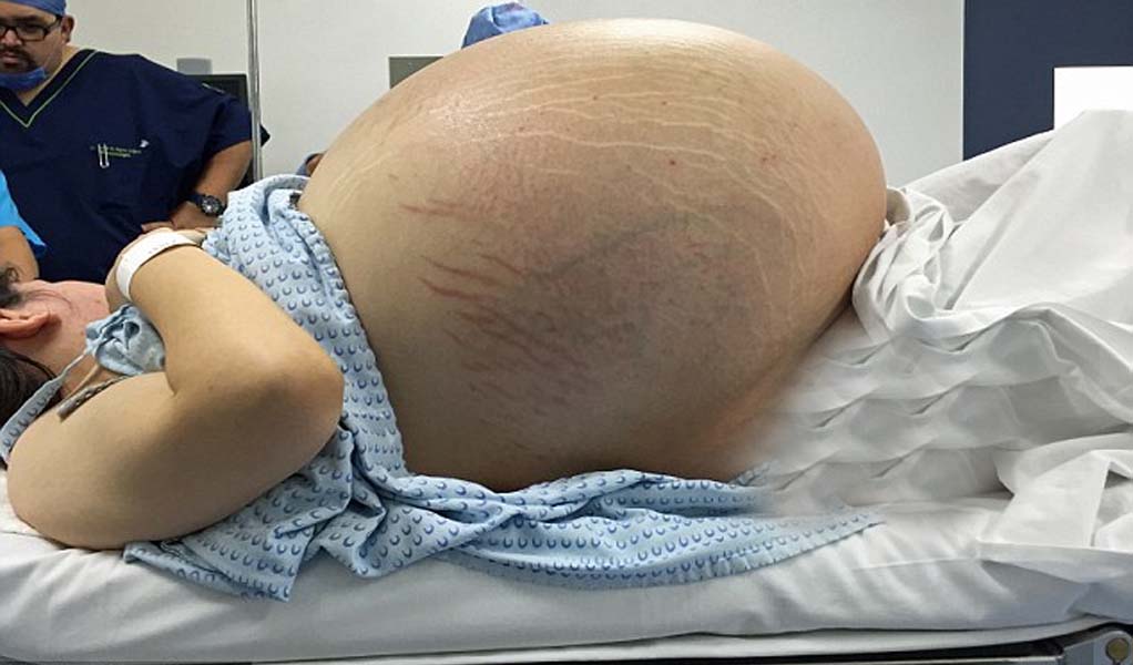 सभी उसे गर्भवती समझ रहे थे, ऑपरेशन के बाद पेट से जो निकला उसे देखकर सब हैरान हो गए