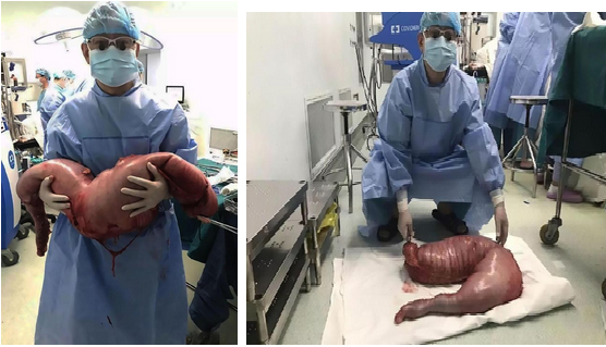 चीन के इस आदमी के पेट से निकली ऐसी चीज देखकर डाॅक्टर भी हो गए परेशान